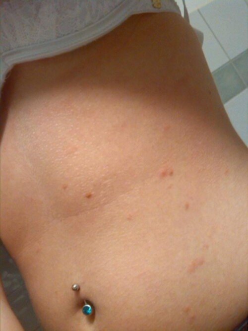 utslag virus vuxna utslag virus vuxna