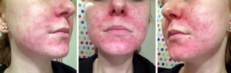 perioral dermatit antibiotika perioral dermatit antibiotika